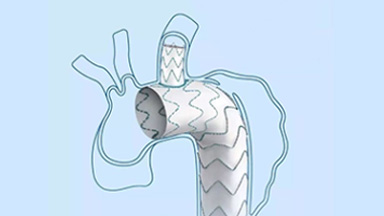 多分支人工血管覆膜支架系統(tǒng)（華脈泰科）