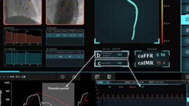 冠狀動(dòng)脈血流儲(chǔ)備分?jǐn)?shù)測(cè)量系統(tǒng)（蘇州潤(rùn)邁德）